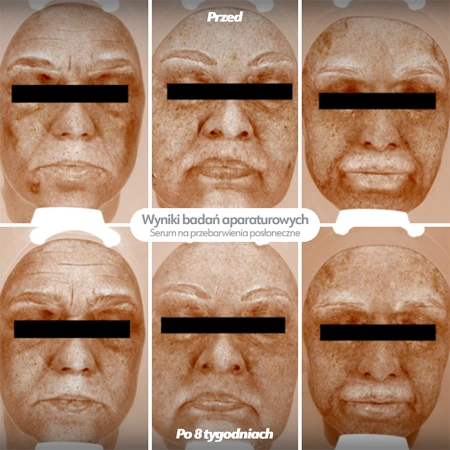 Serum na przebarwienia posłoneczne KRÓTKI TERMIN