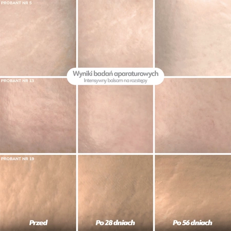 Intensywny balsam na rozstępy